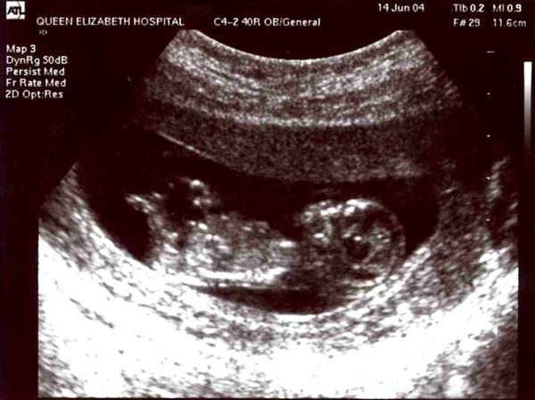 Zachary's Original Scan